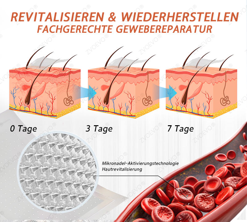 💐🎁Zvoevo® Vein Ease Mikronadel Pflegepflaster (Für Besenreiser, Krampfadern, Schwellungen & Beinermüdung)