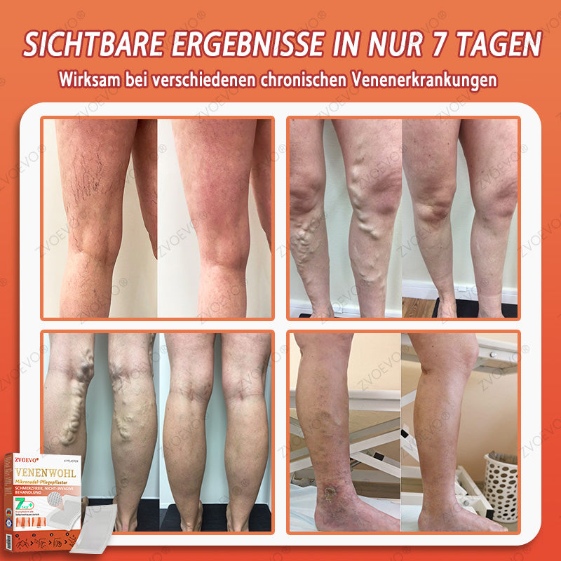 💐🎁Zvoevo® Vein Ease Mikronadel Pflegepflaster (Für Besenreiser, Krampfadern, Schwellungen & Beinermüdung)