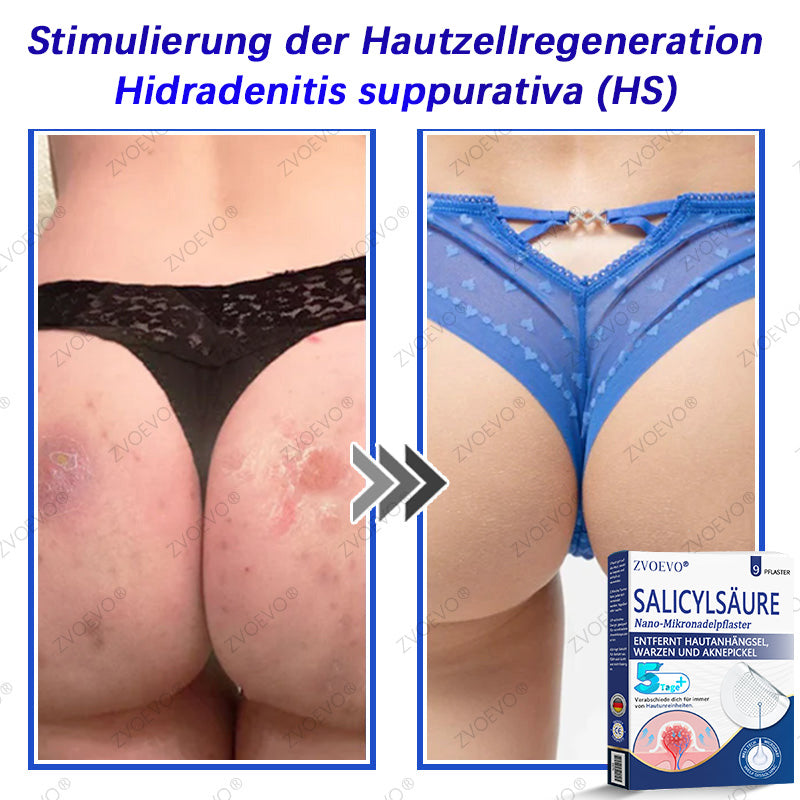💐🔥【Offizieller Store】Zvoevo® Salicylsäure-Nano-Mikronadel-Pflaster (gegen Hautanhängsel, Warzen & Aknepickel)