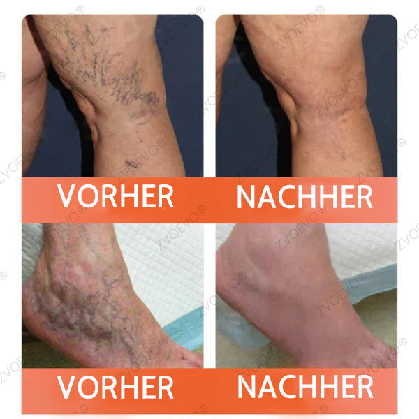 💐🎁Zvoevo® Vein Ease Mikronadel Pflegepflaster (Für Besenreiser, Krampfadern, Schwellungen & Beinermüdung)
