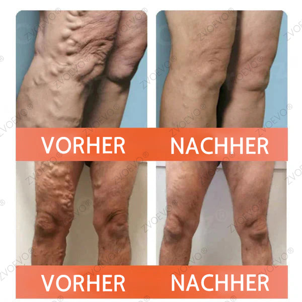 💐🎁Zvoevo® Vein Ease Mikronadel Pflegepflaster (Für Besenreiser, Krampfadern, Schwellungen & Beinermüdung)