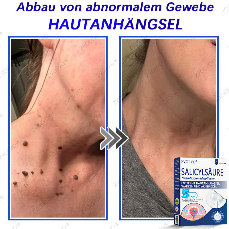 💐🔥【Offizieller Store】Zvoevo® Salicylsäure-Nano-Mikronadel-Pflaster (gegen Hautanhängsel, Warzen & Aknepickel)