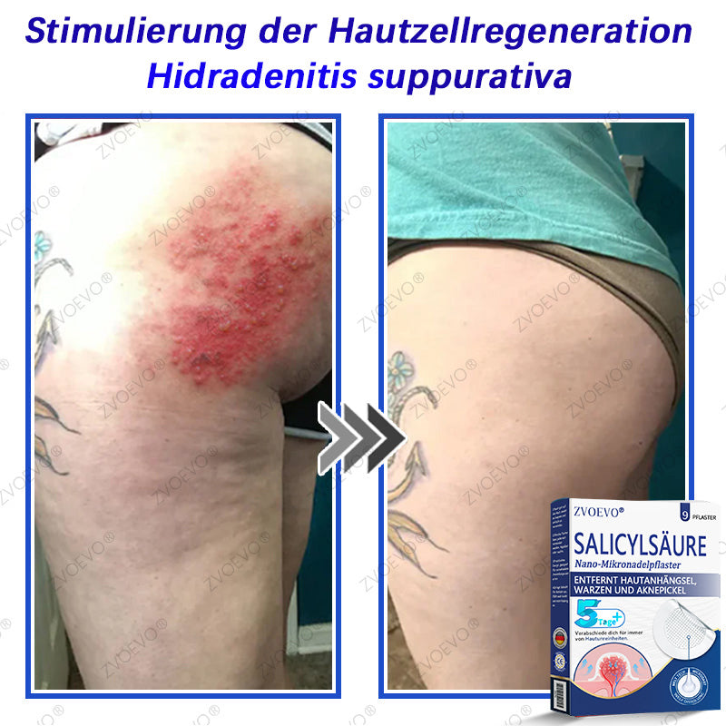 💐🔥【Offizieller Store】Zvoevo® Salicylsäure-Nano-Mikronadel-Pflaster (gegen Hautanhängsel, Warzen & Aknepickel)