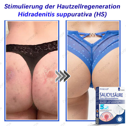 💐🔥【Offizieller Store】Zvoevo® Salicylsäure-Nano-Mikronadel-Pflaster (gegen Hautanhängsel, Warzen & Aknepickel)