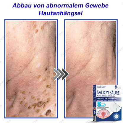 💐🔥【Offizieller Store】Zvoevo® Salicylsäure-Nano-Mikronadel-Pflaster (gegen Hautanhängsel, Warzen & Aknepickel)