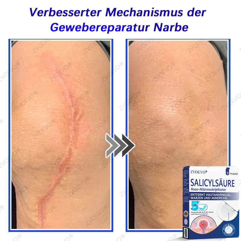 💐🔥【Offizieller Store】Zvoevo® Salicylsäure-Nano-Mikronadel-Pflaster (gegen Hautanhängsel, Warzen & Aknepickel)