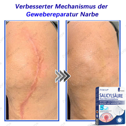 💐🔥【Offizieller Store】Zvoevo® Salicylsäure-Nano-Mikronadel-Pflaster (gegen Hautanhängsel, Warzen & Aknepickel)