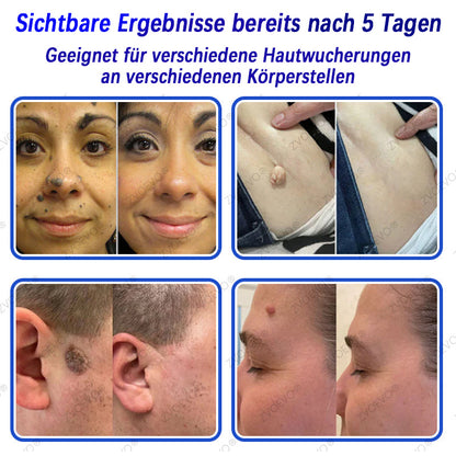 💐🔥【Offizieller Store】Zvoevo® Salicylsäure-Nano-Mikronadel-Pflaster (gegen Hautanhängsel, Warzen & Aknepickel)