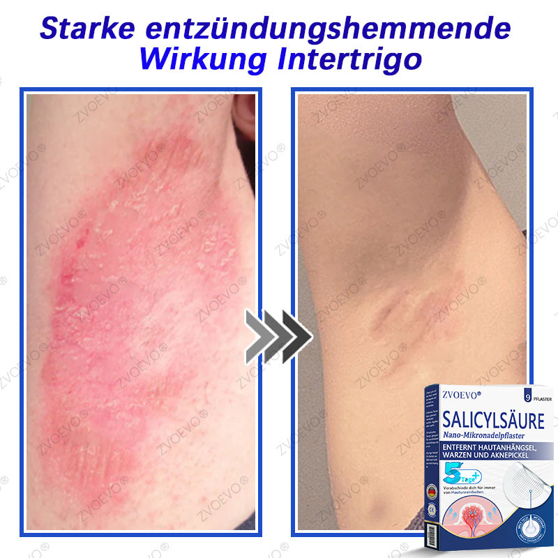💐🔥【Offizieller Store】Zvoevo® Salicylsäure-Nano-Mikronadel-Pflaster (gegen Hautanhängsel, Warzen & Aknepickel)