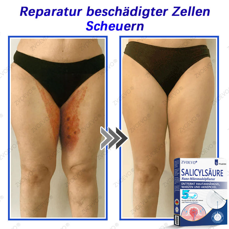 💐🔥【Offizieller Store】Zvoevo® Salicylsäure-Nano-Mikronadel-Pflaster (gegen Hautanhängsel, Warzen & Aknepickel)