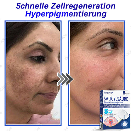 💐🔥【Offizieller Store】Zvoevo® Salicylsäure-Nano-Mikronadel-Pflaster (gegen Hautanhängsel, Warzen & Aknepickel)