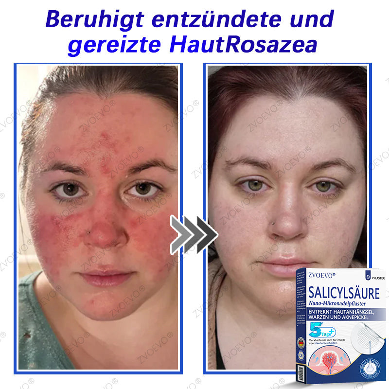 💐🔥【Offizieller Store】Zvoevo® Salicylsäure-Nano-Mikronadel-Pflaster (gegen Hautanhängsel, Warzen & Aknepickel)