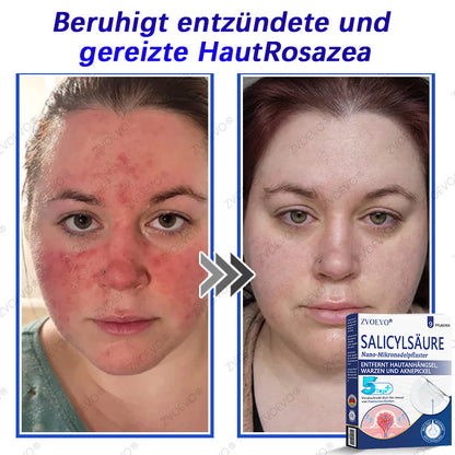 💐🔥【Offizieller Store】Zvoevo® Salicylsäure-Nano-Mikronadel-Pflaster (gegen Hautanhängsel, Warzen & Aknepickel)